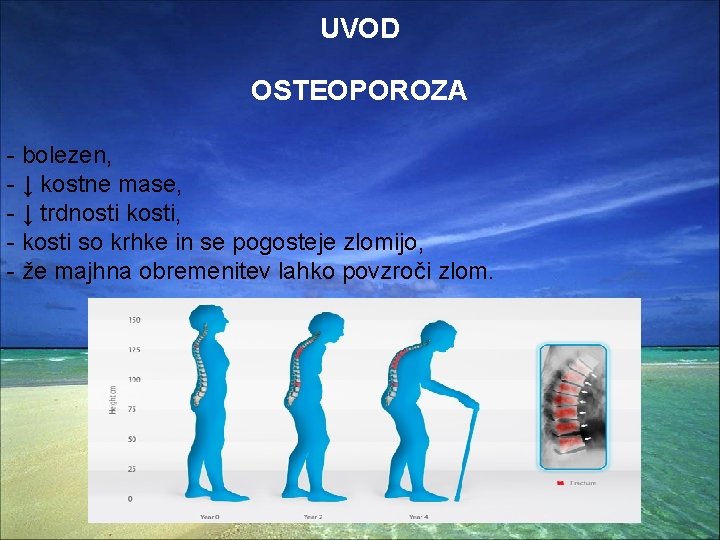 UVOD OSTEOPOROZA - bolezen, - ↓ kostne mase, - ↓ trdnosti kosti, - kosti