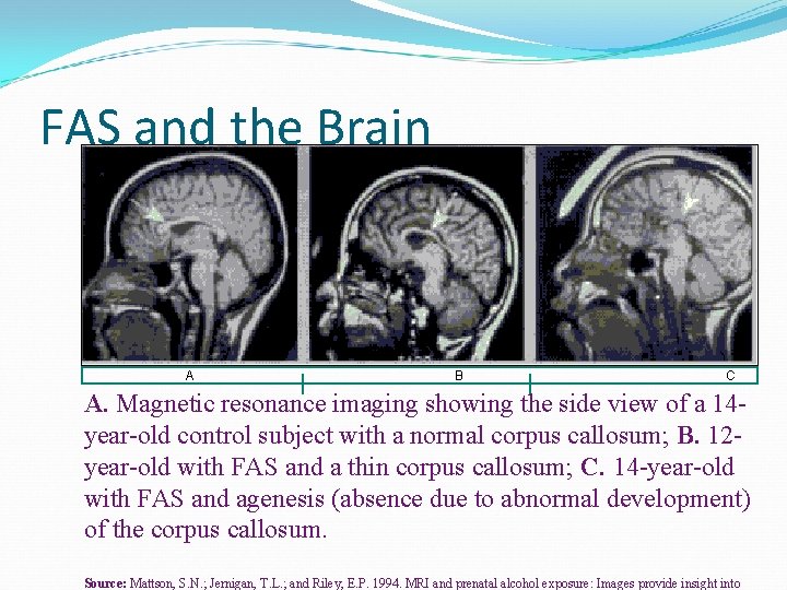 FAS and the Brain A A B C A. Magnetic resonance imaging showing the