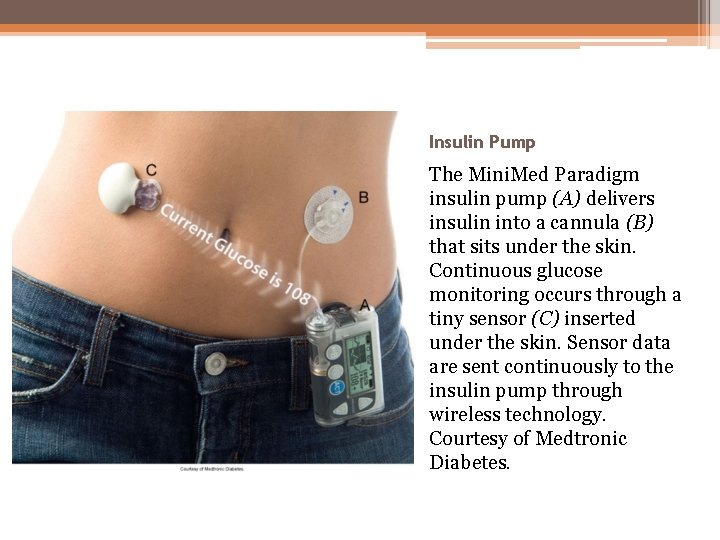 Insulin Pump The Mini. Med Paradigm insulin pump (A) delivers insulin into a cannula