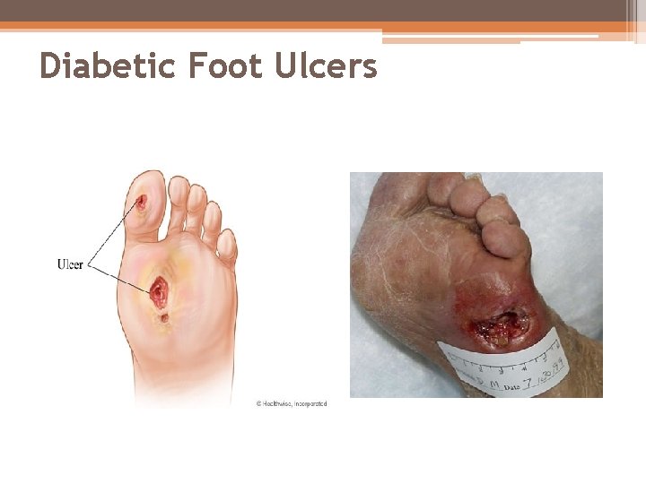 Diabetic Foot Ulcers 