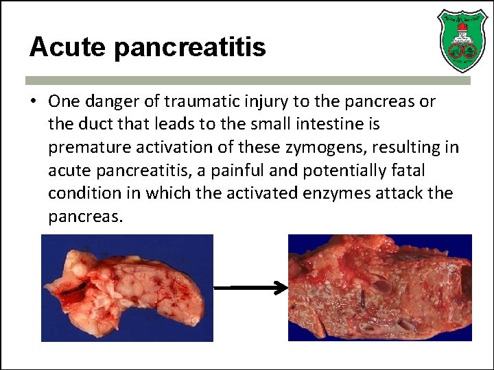 Acute pancreatitis • One danger of traumatic injury to the pancreas or the duct