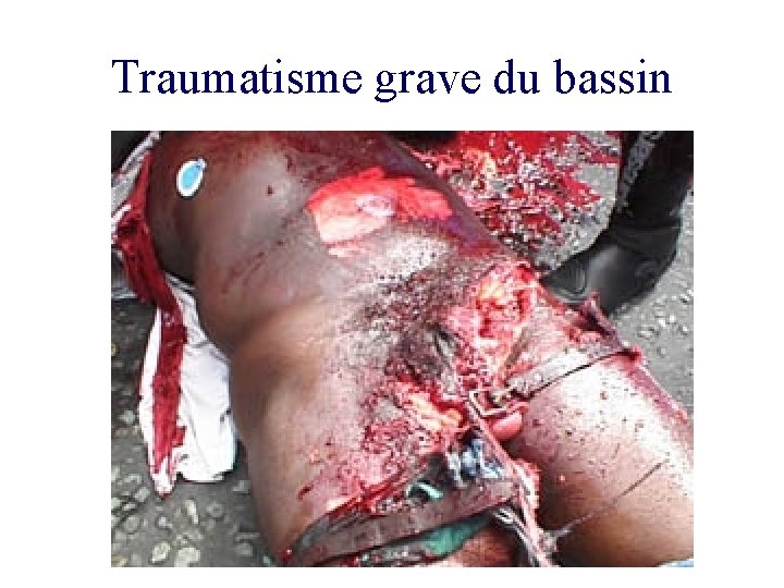 Traumatisme grave du bassin 