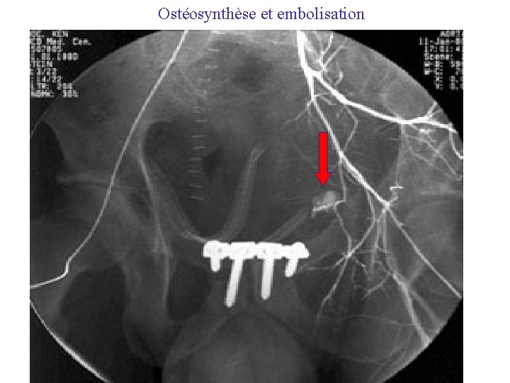 Ostéosynthèse et embolisation 