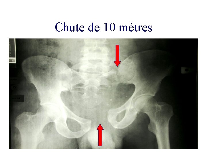 Chute de 10 mètres 