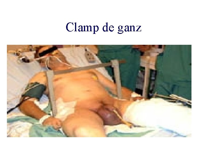 Clamp de ganz 