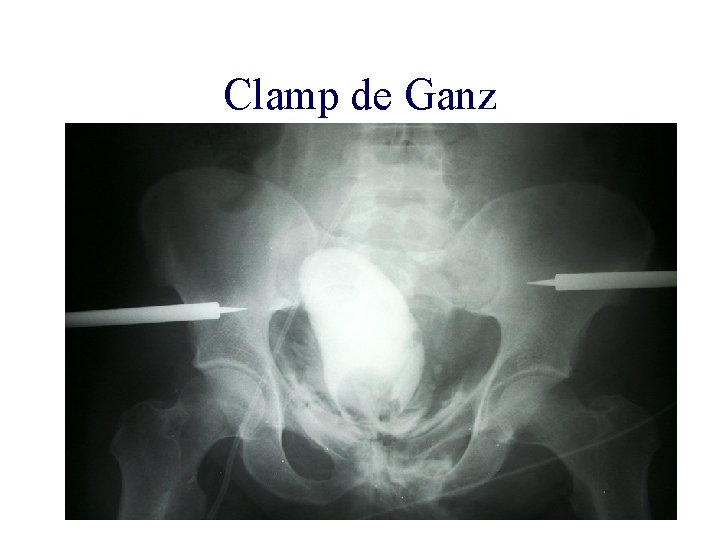 Clamp de Ganz 