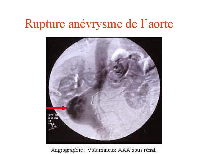 Rupture anévrysme de l’aorte 