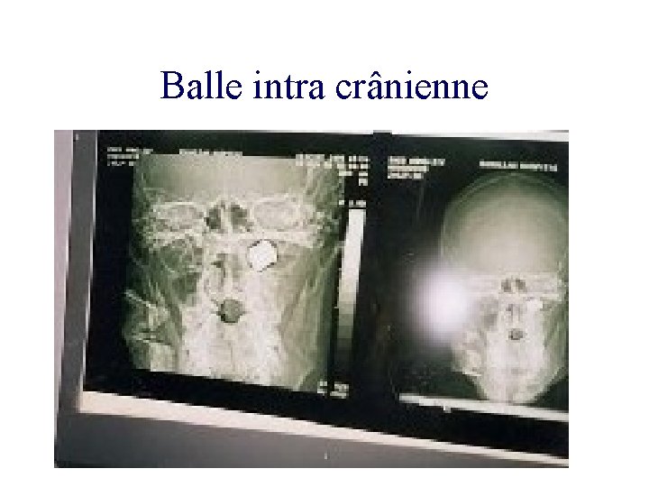 Balle intra crânienne 