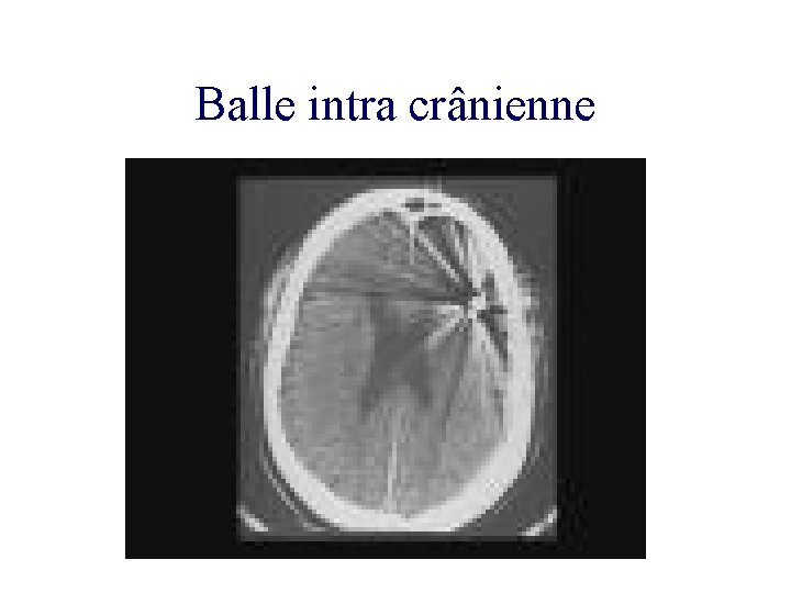 Balle intra crânienne 