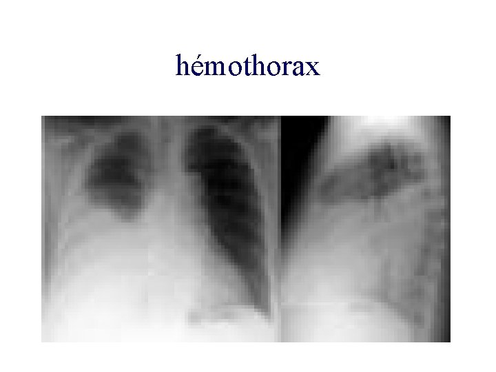 hémothorax 