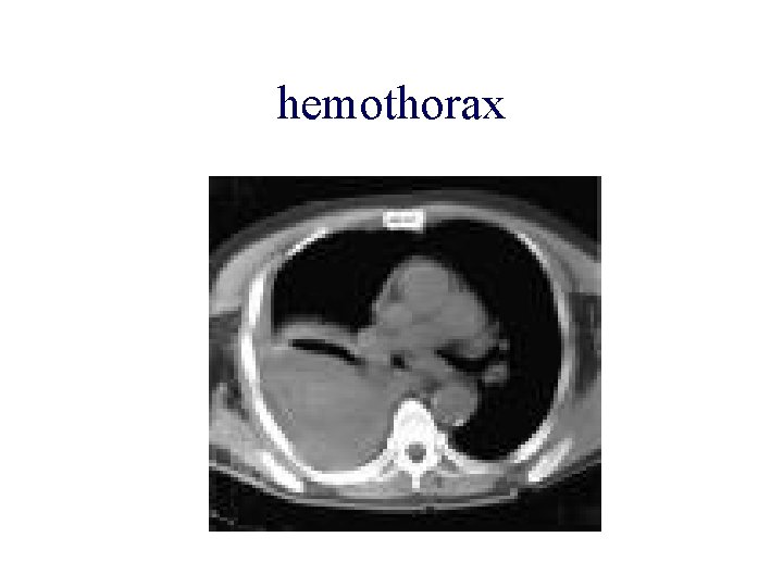 hemothorax 