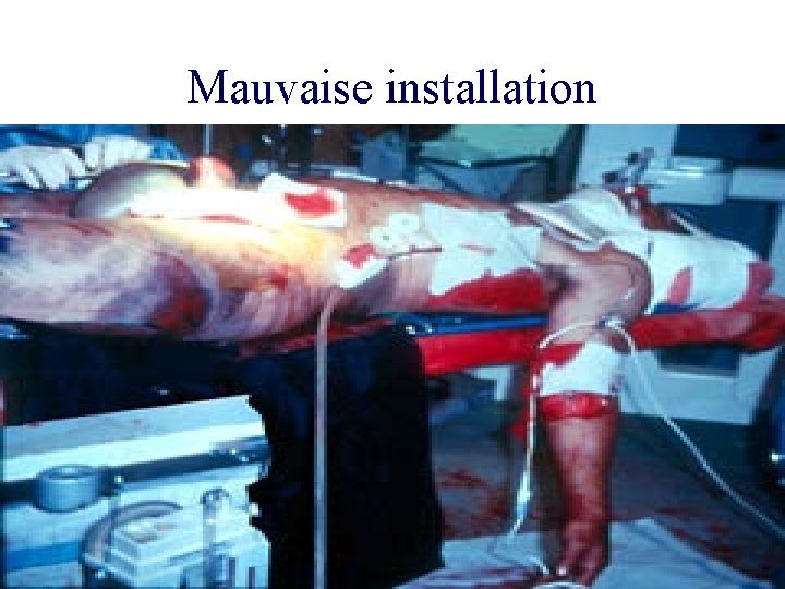 Mauvaise installation 