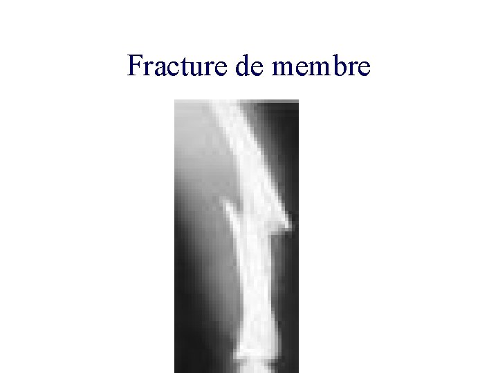 Fracture de membre 