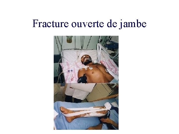 Fracture ouverte de jambe 