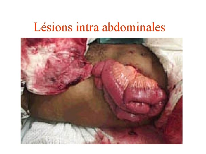 Lésions intra abdominales 