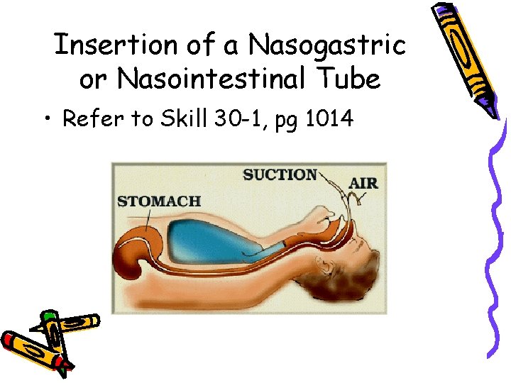 Insertion of a Nasogastric or Nasointestinal Tube • Refer to Skill 30 -1, pg