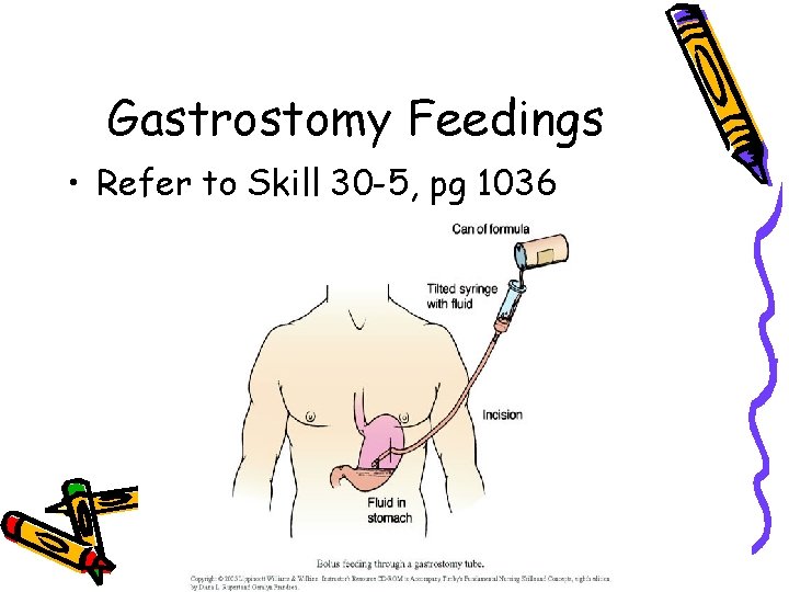 Gastrostomy Feedings • Refer to Skill 30 -5, pg 1036 