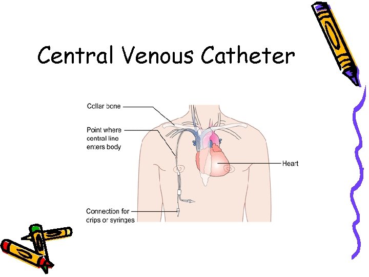 Central Venous Catheter 