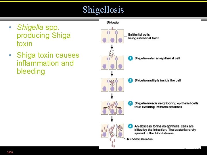 Shigellosis • Shigella spp. producing Shiga toxin • Shiga toxin causes inflammation and bleeding