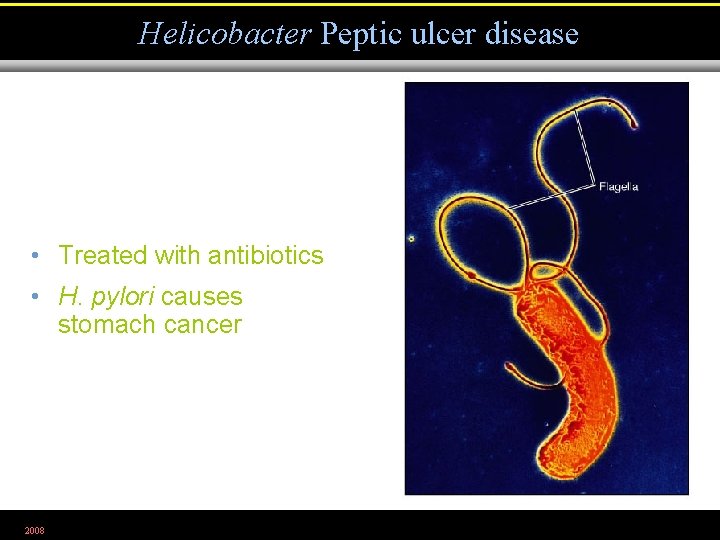 Helicobacter Peptic ulcer disease • Treated with antibiotics • H. pylori causes stomach cancer