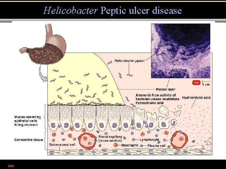Helicobacter Peptic ulcer disease 2008 Figure 25. 13 