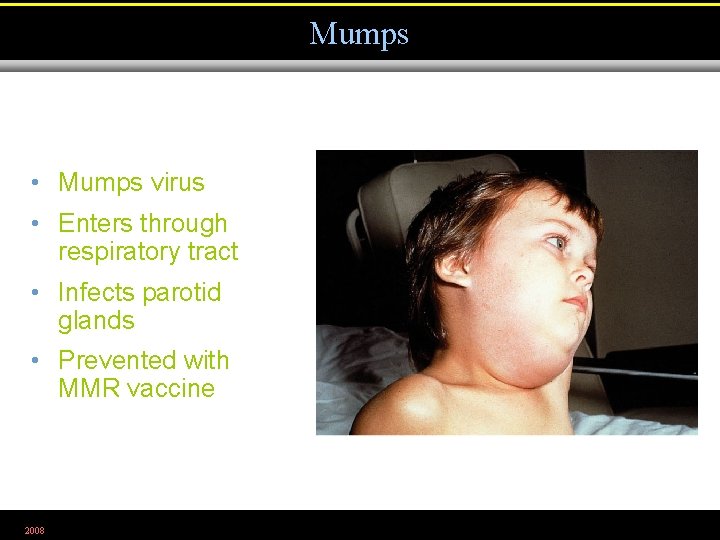 Mumps • Mumps virus • Enters through respiratory tract • Infects parotid glands •