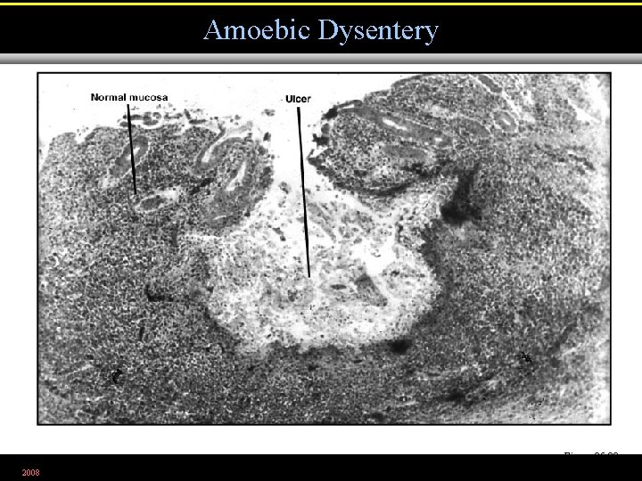 Amoebic Dysentery Figure 25. 20 2008 