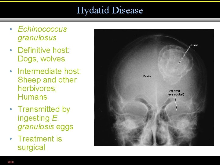 Hydatid Disease • Echinococcus granulosus • Definitive host: Dogs, wolves • Intermediate host: Sheep