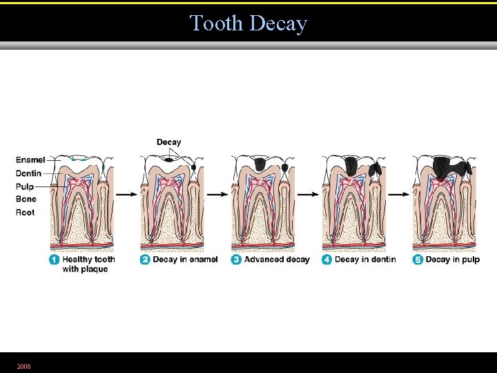 Tooth Decay 2008 Figure 25. 4 