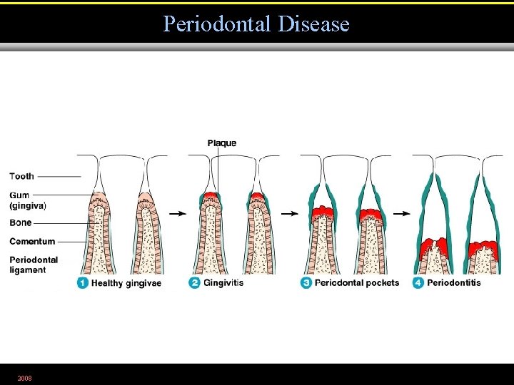 Periodontal Disease 2008 Figure 25. 5 
