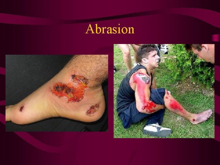 Abrasion 