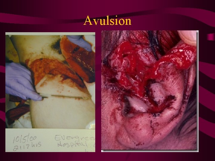 Avulsion 