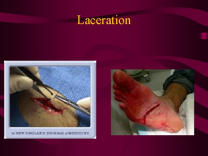 Laceration 