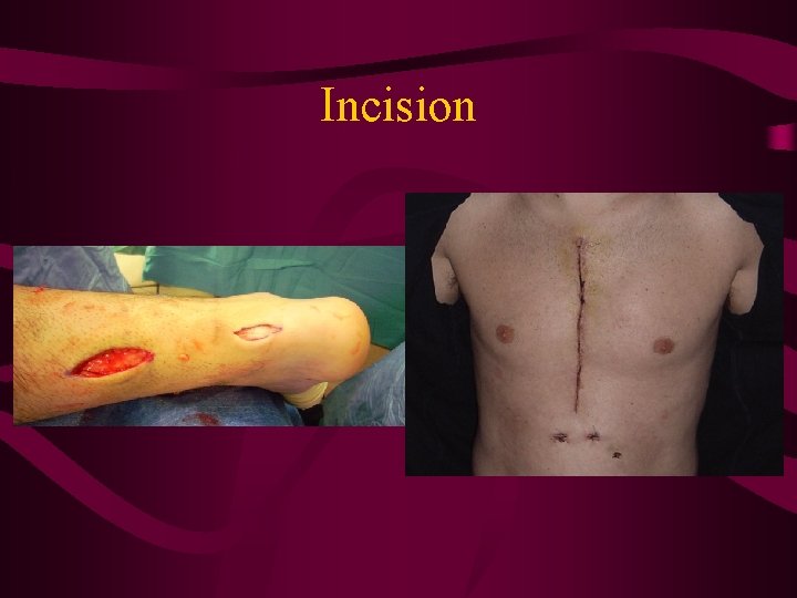 Incision 