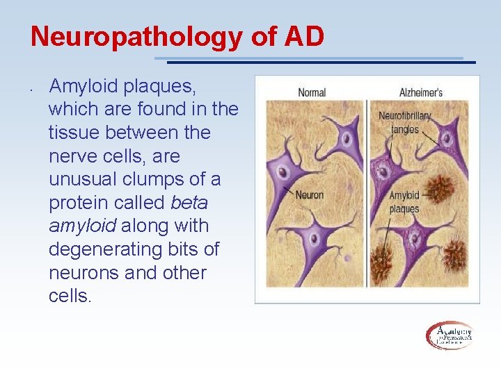 Neuropathology of AD • Amyloid plaques, which are found in the tissue between the
