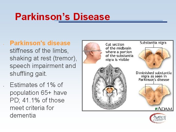 Parkinson’s Disease • • Parkinson's disease stiffness of the limbs, shaking at rest (tremor),