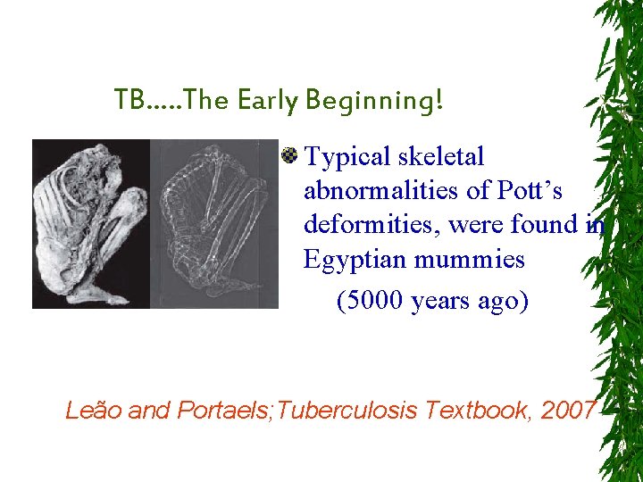 TB…. . The Early Beginning! Typical skeletal abnormalities of Pott’s deformities, were found in