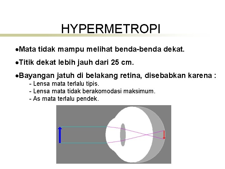 HYPERMETROPI Mata tidak mampu melihat benda-benda dekat. Titik dekat lebih jauh dari 25 cm.