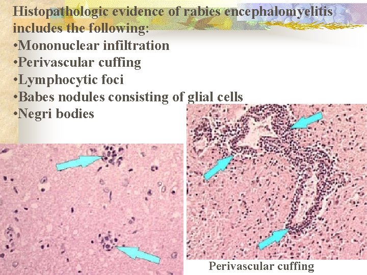 Histopathologic evidence of rabies encephalomyelitis includes the following: • Mononuclear infiltration • Perivascular cuffing