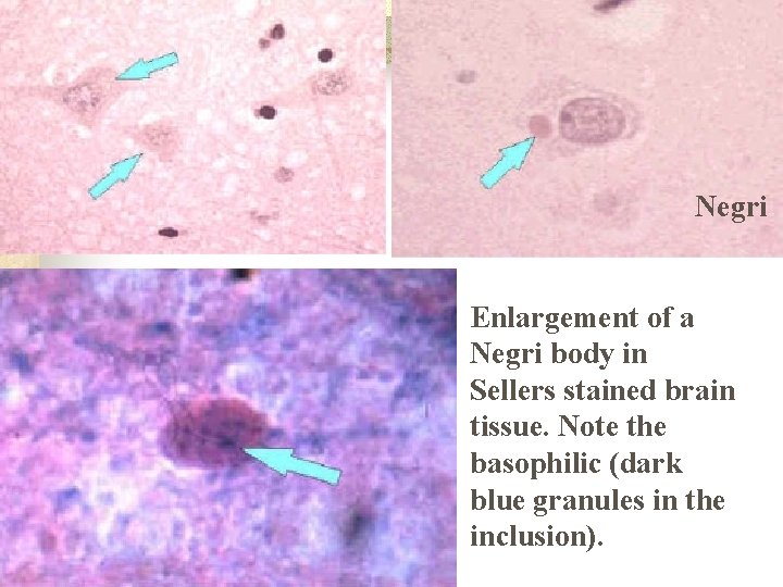 Negri Enlargement of a Negri body in Sellers stained brain tissue. Note the basophilic