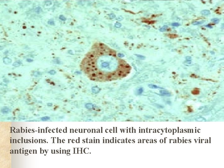 Rabies-infected neuronal cell with intracytoplasmic inclusions. The red stain indicates areas of rabies viral