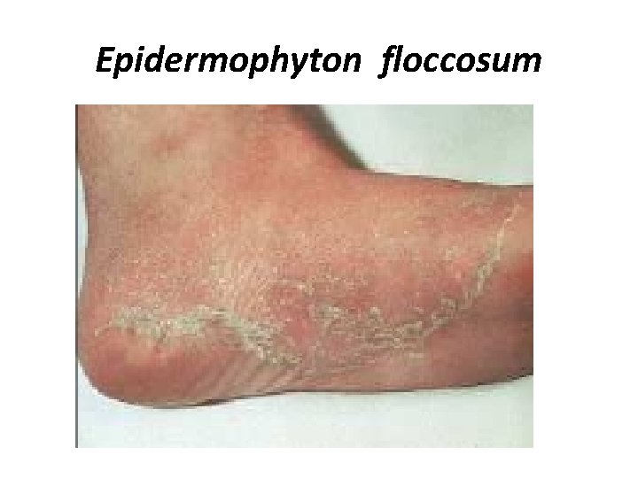 Epidermophyton floccosum 