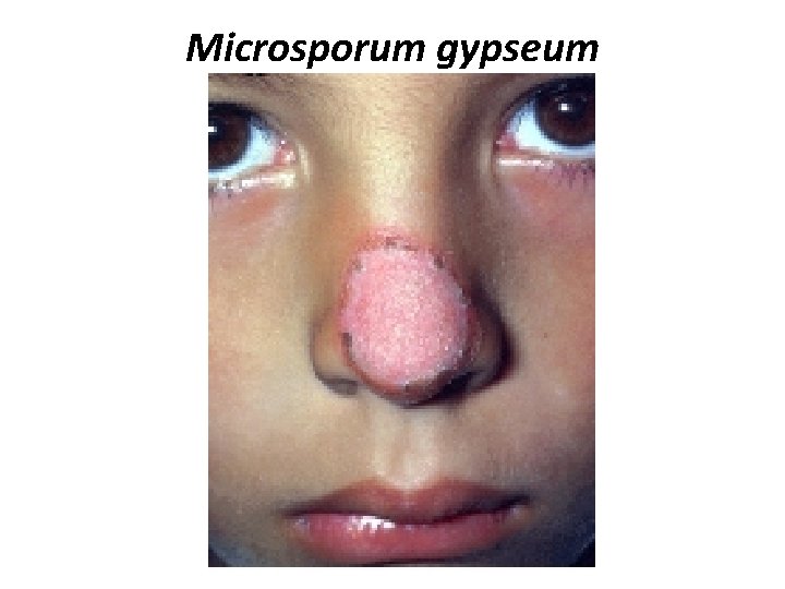 Microsporum gypseum 