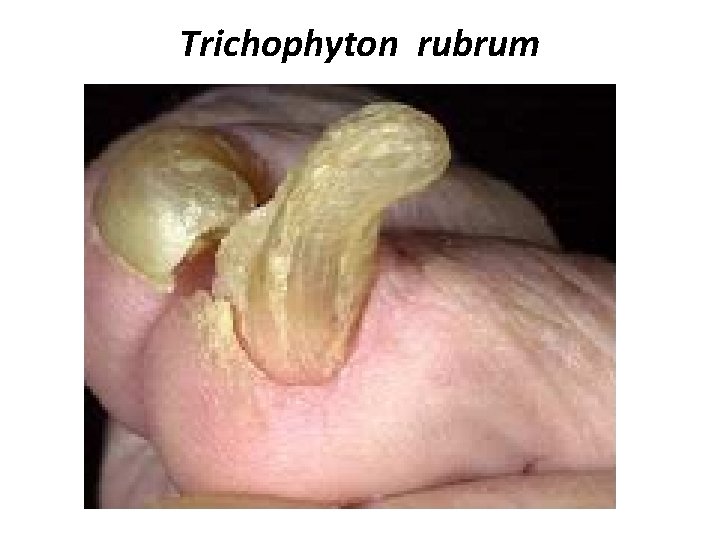 Trichophyton rubrum 