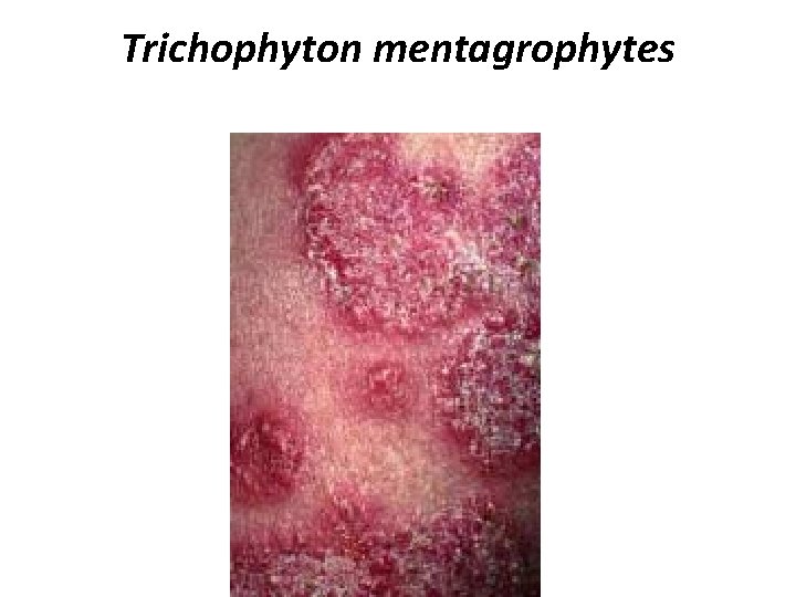 Trichophyton mentagrophytes 