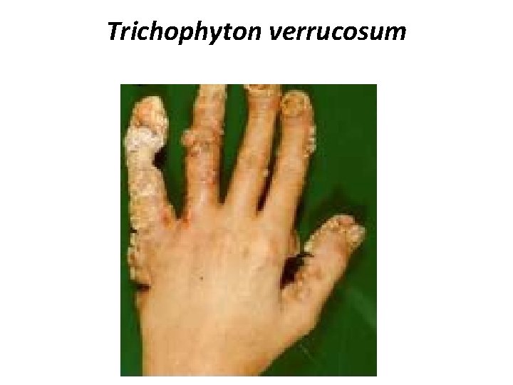 Trichophyton verrucosum 
