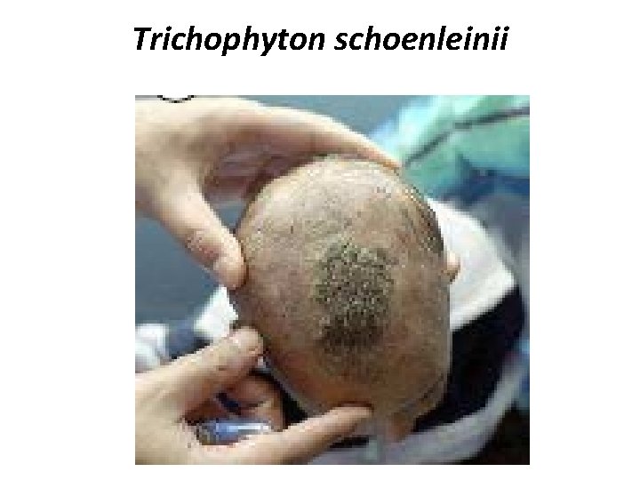 Trichophyton schoenleinii 