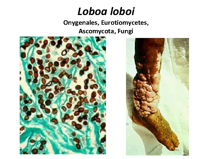 Loboa loboi Onygenales, Eurotiomycetes, Ascomycota, Fungi 
