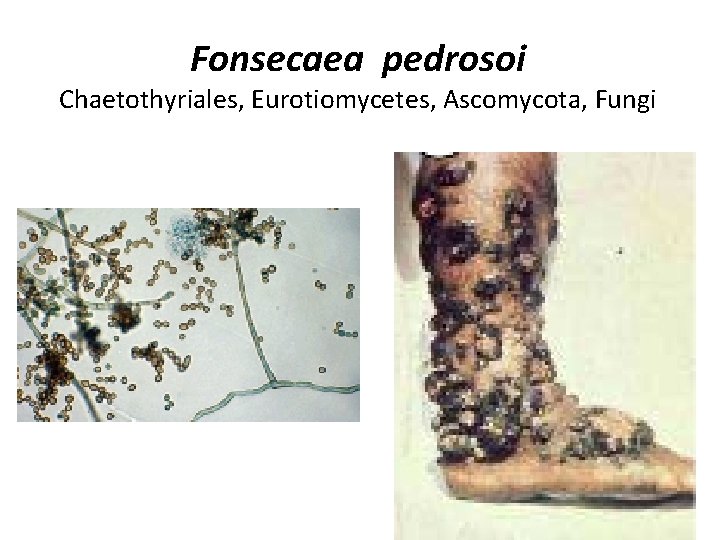 Fonsecaea pedrosoi Chaetothyriales, Eurotiomycetes, Ascomycota, Fungi 