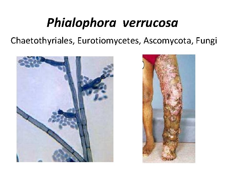 Phialophora verrucosa Chaetothyriales, Eurotiomycetes, Ascomycota, Fungi 